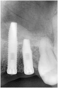 川畑4(3)　埋入時拡大　サイナスリフト